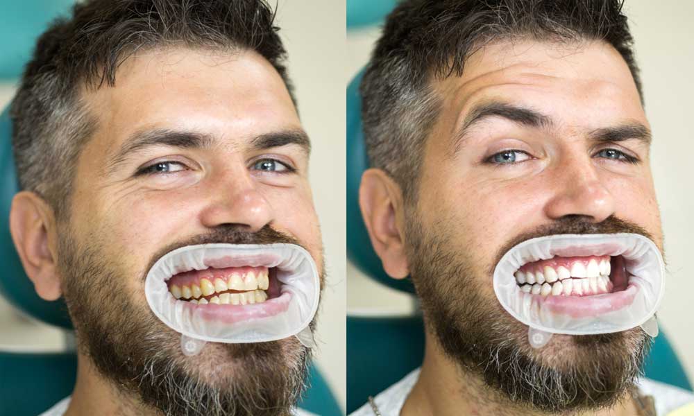San Diego Teeth Whitening